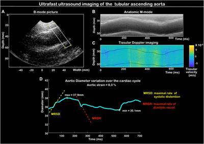 Methods: Aortic wall deformation assessment by ultrafast ultrasound imaging: Application to bicuspid aortic valve associated aortopathy